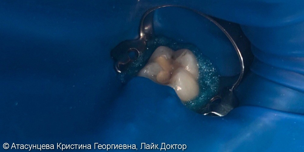 Лечение кариеса зубов - фото №1