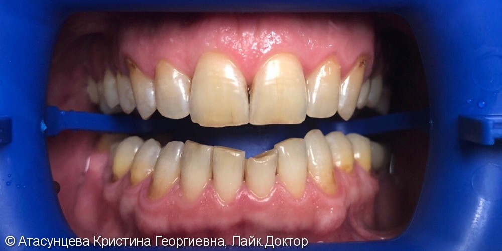 Профессиональное отбеливание зубов системой Zoom 4 - фото №1