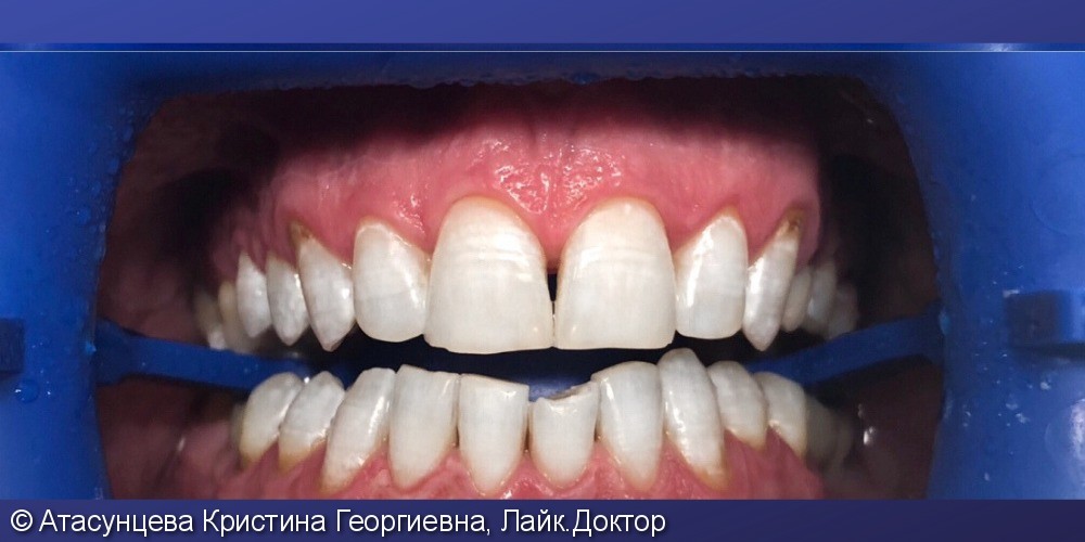 Профессиональное отбеливание зубов системой Zoom 4 - фото №2