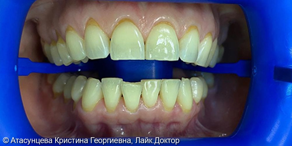 Отбеливание зубов системой Zoom 4 - фото №1