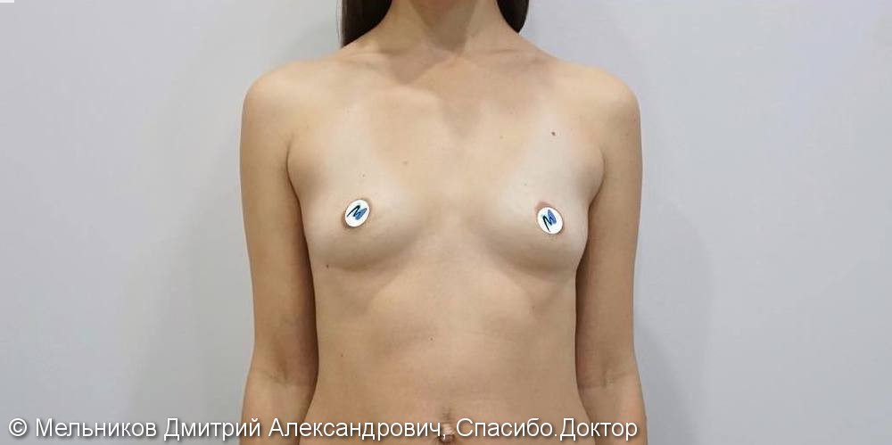 Результат увеличения груди анатомическими имплантами, фото до и после - фото №1