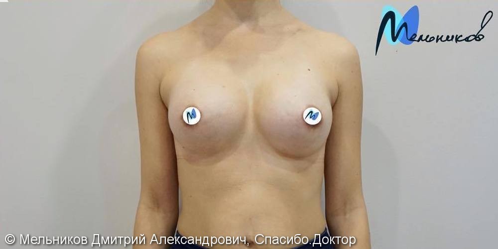 Результат увеличения груди анатомическими имплантами, фото до и после - фото №2
