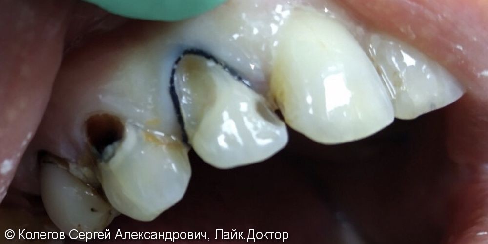 Лечение пришеечного кариеса 12,13 зубов - фото №1