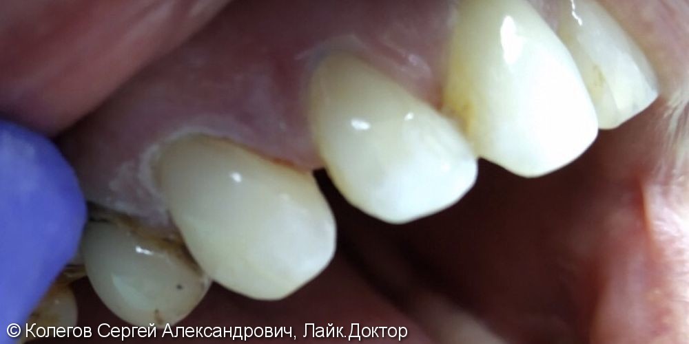 Лечение пришеечного кариеса 12,13 зубов - фото №2