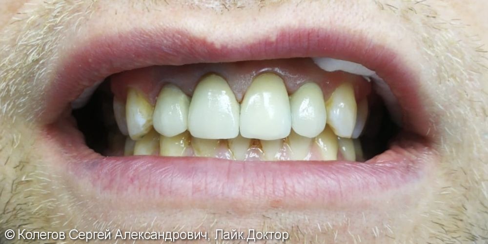Установка винира e-max press на 21 зуб и коронок на 11,12 и 22 зубы - фото №2