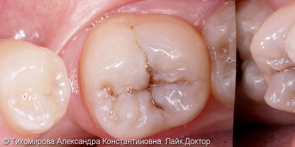 Лечение кариеса зуба 3.6 - фото №1