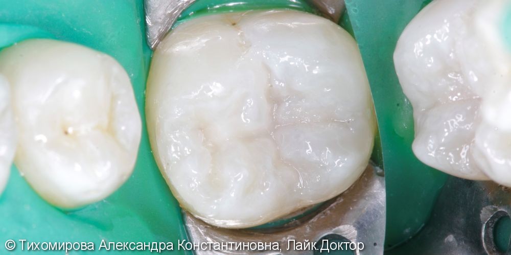 Лечение кариеса зуба 3.6 - фото №3
