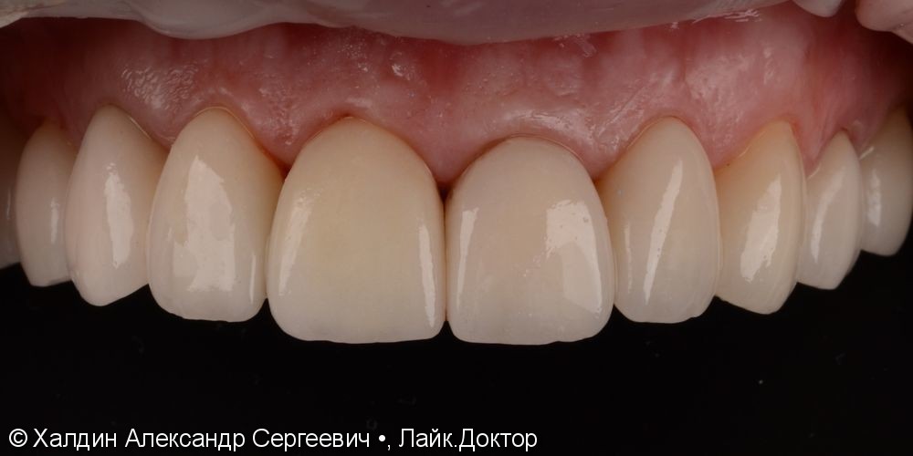 10 керамических виниров и коронок Е.мах на зубы верхней челюсти - фото №2