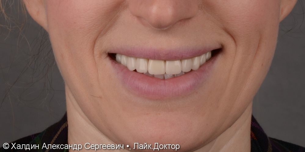 10 керамических виниров и коронок Е.мах на зубы верхней челюсти - фото №3
