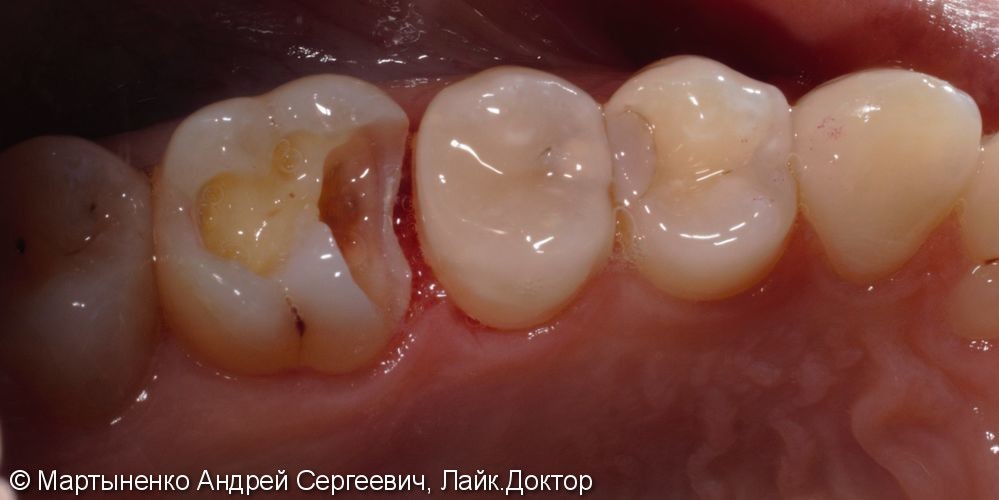 Лечение глубокого кариеса и постановка керамической вкладки на зуб - фото №1