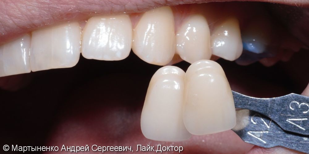 Лечение глубокого кариеса и постановка керамической вкладки на зуб - фото №2