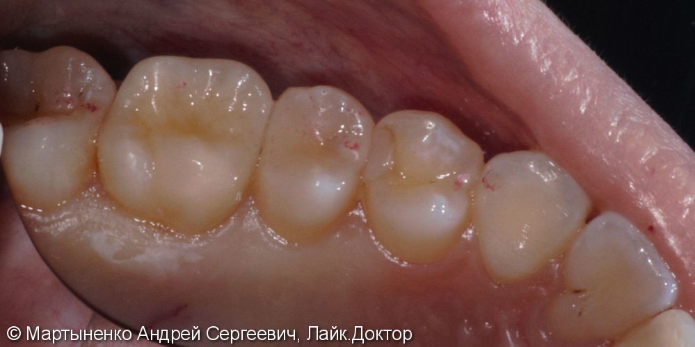 Лечение глубокого кариеса и постановка керамической вкладки на зуб - фото №3