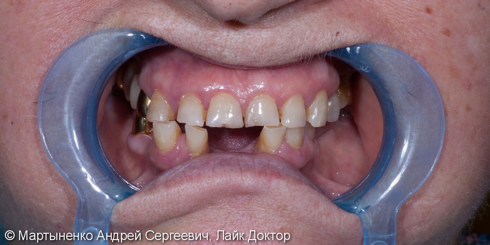 Бюгельный протез на передние и жевательные зубы, до и после - фото №1