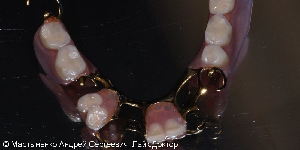Бюгельный протез на передние и жевательные зубы, до и после - фото №2
