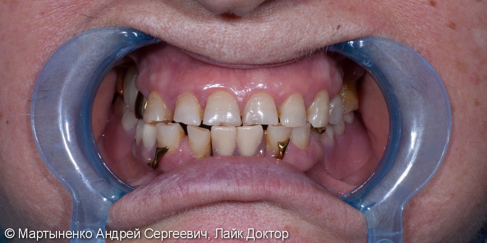 Бюгельный протез на передние и жевательные зубы, до и после - фото №3
