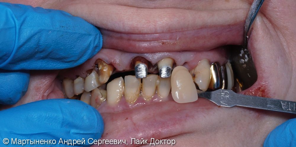Металлокерамический мостовидный протез на зубы - фото №1