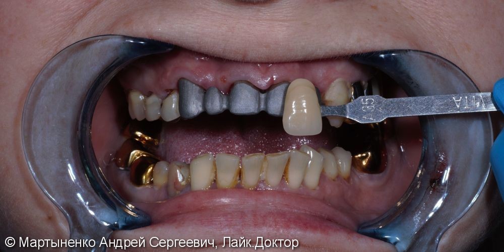 Металлокерамический мостовидный протез на зубы - фото №2