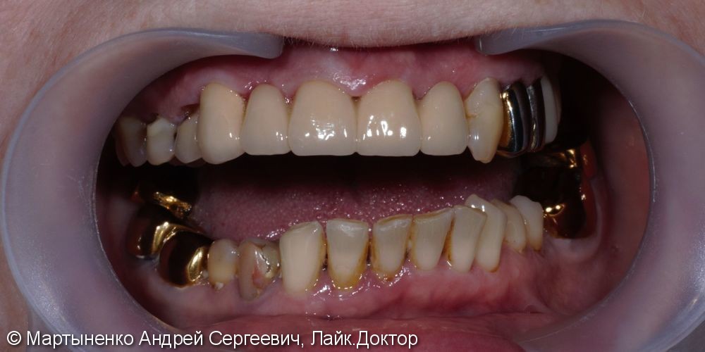 Металлокерамический мостовидный протез на зубы - фото №3