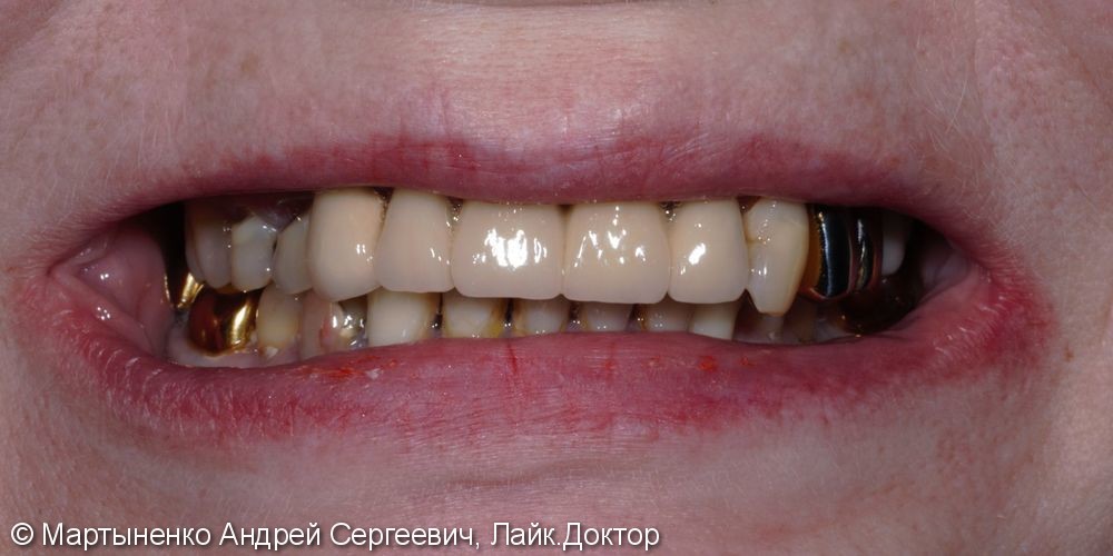 Металлокерамический мостовидный протез на зубы - фото №4