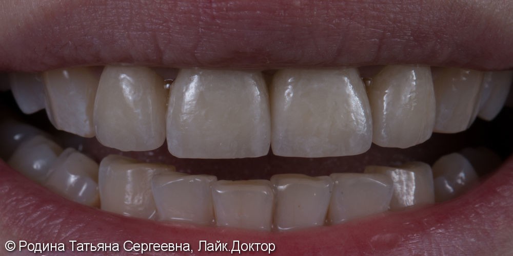 Керамические виниры на передние зубы со сколами - фото №2