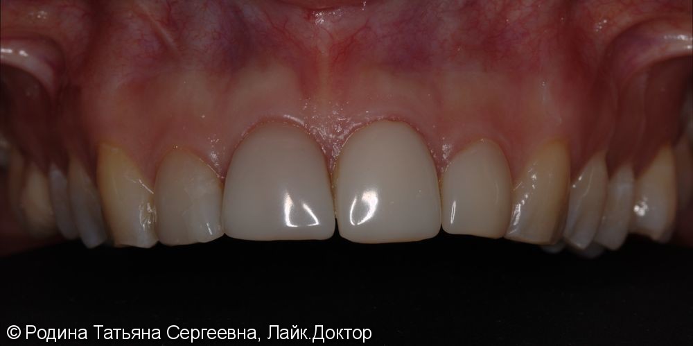 Керамические виниры на передние зубы со сколами - фото №1