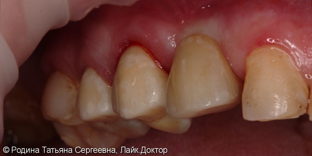Комплексное стоматологическое лечение - фото №2