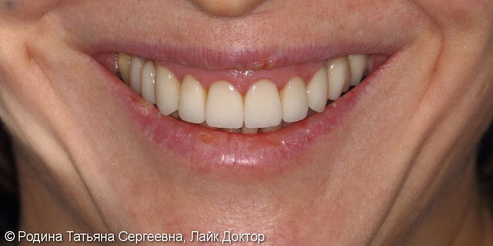 Комплексная стоматологическая реабилитация - фото №2