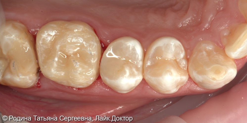 Установка коронок на зубы 1.6 и 2.6 - фото №2