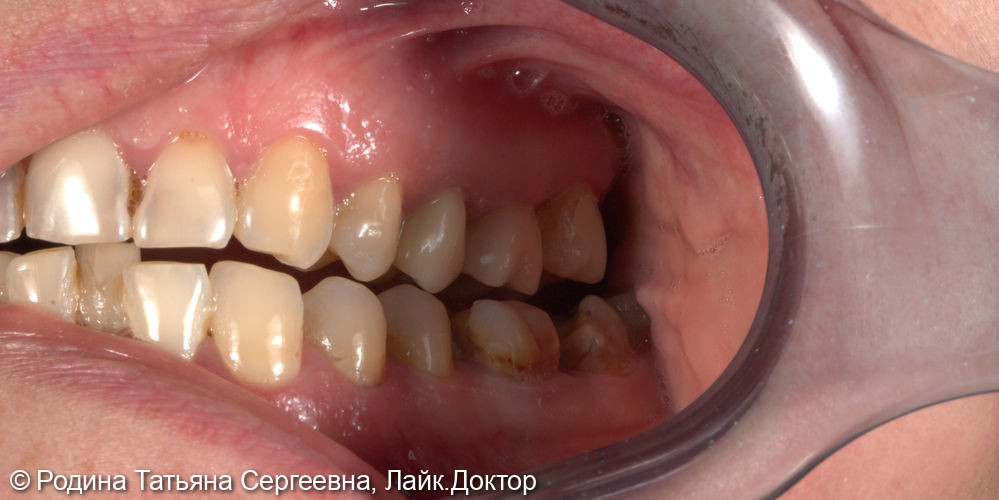 Восстановление зубов 2.5 и 2.6 коронками - фото №2