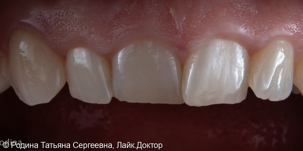 Восстановление зуба 2.3 керамической коронкой - фото №1