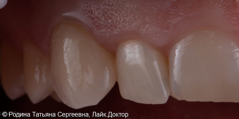 Восстановление зуба 2.3 керамической коронкой - фото №2