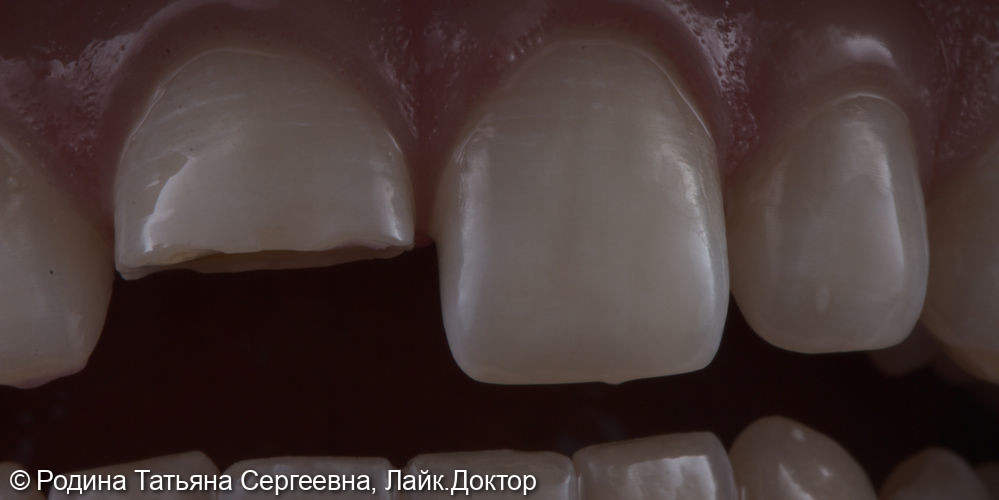 Восстановление травмированного зуба 1.1 - фото №1