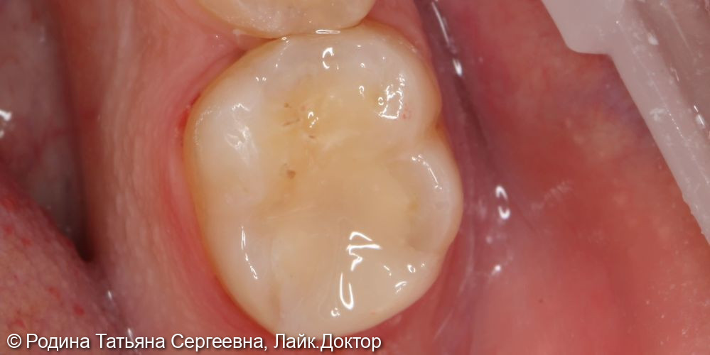 Восстановление жевательной поверхности зуба - фото №2