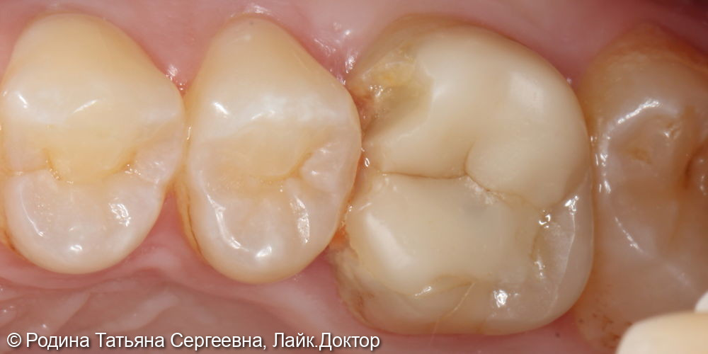Лечение разрушенного зуба 1.6 - фото №1