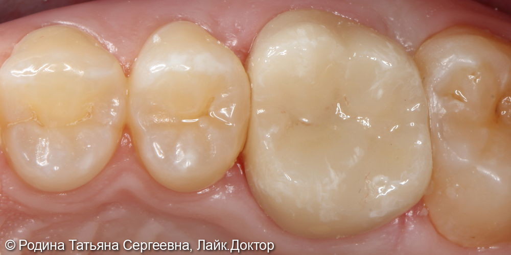 Лечение разрушенного зуба 1.6 - фото №2