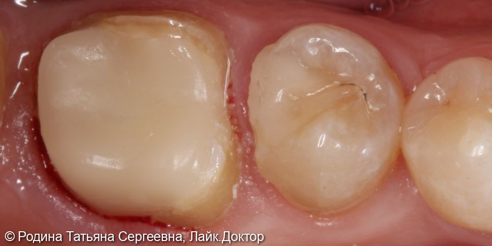 Лечение разрушенного более 80 % зуба 3.6 - фото №2