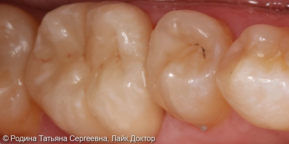 Лечение разрушенного более 80 % зуба 3.6 - фото №3
