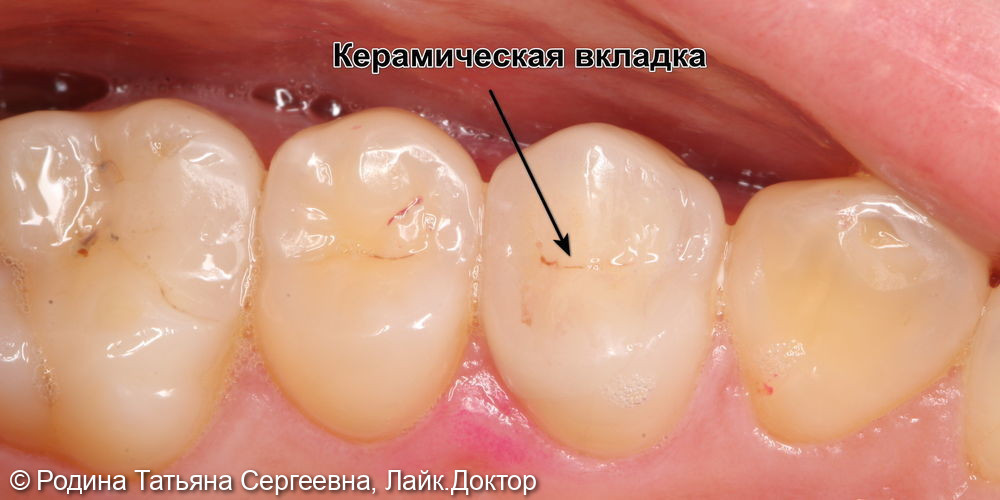 Лечение кариеса и скола зуба 2.4 - фото №1