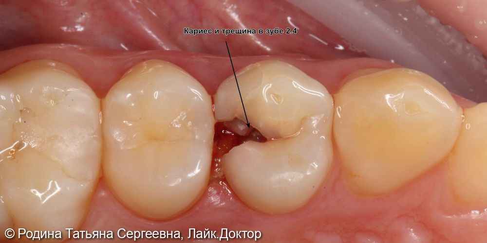 Лечение кариеса и скола зуба 2.4 - фото №2
