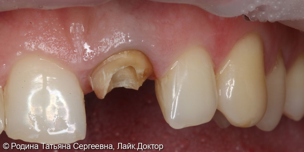 Восстановление центрального зуба 2.1 культевой вкладкой и керамической коронкой - фото №3