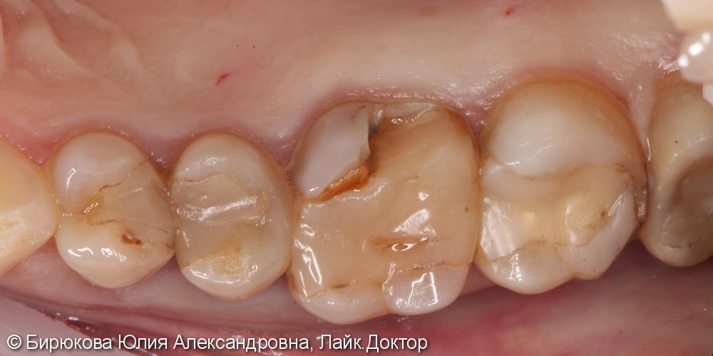 Реставрация жевательного зуба и лечение кариеса 3х зубов - фото №1
