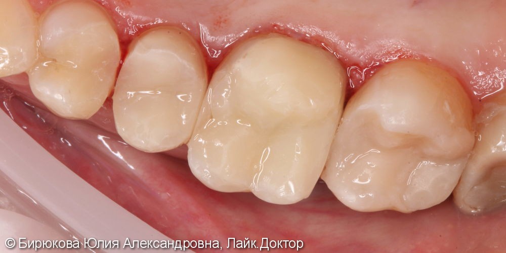 Реставрация жевательного зуба и лечение кариеса 3х зубов - фото №2