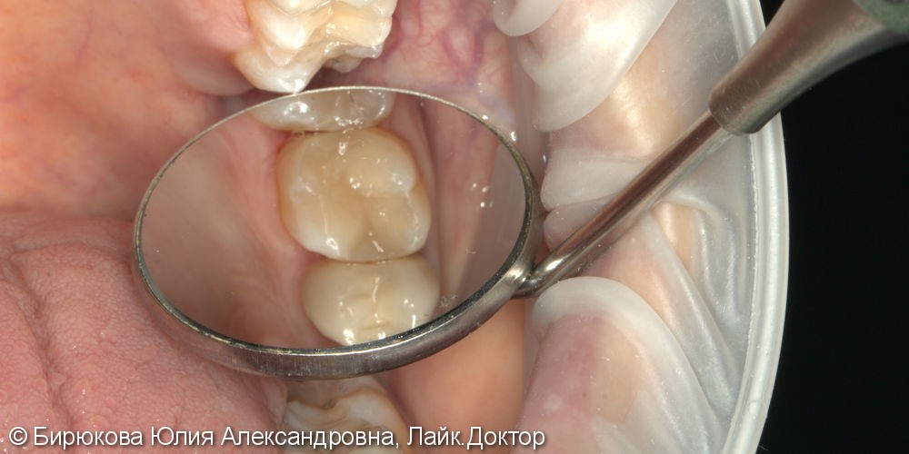 Лечение кариеса зуба 2.6 - фото №2