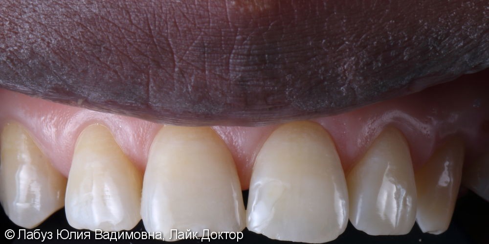 Отбеливание зубов, результат после отбеливания Amazing White - фото №2