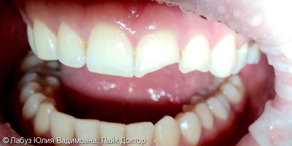 Восстановление переднего зуба - фото №1