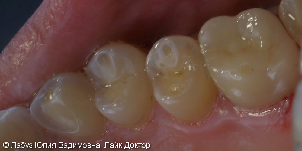 Восстановление анатомической формы зуба 1.6 цельнокерамической коронкой - фото №1