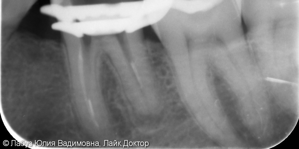 Эндодонтическое лечение зуба - фото №1