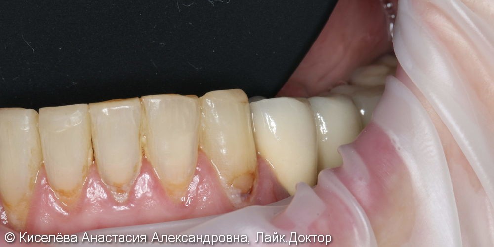 Лечение кариеса 33 зуба, клиновидный дефект результат до и после - фото №1