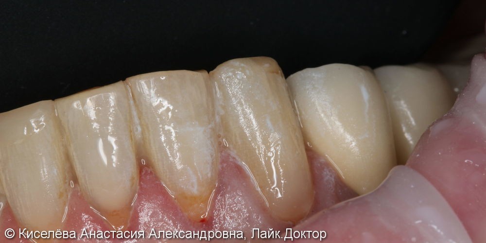 Лечение кариеса 33 зуба, клиновидный дефект результат до и после - фото №2