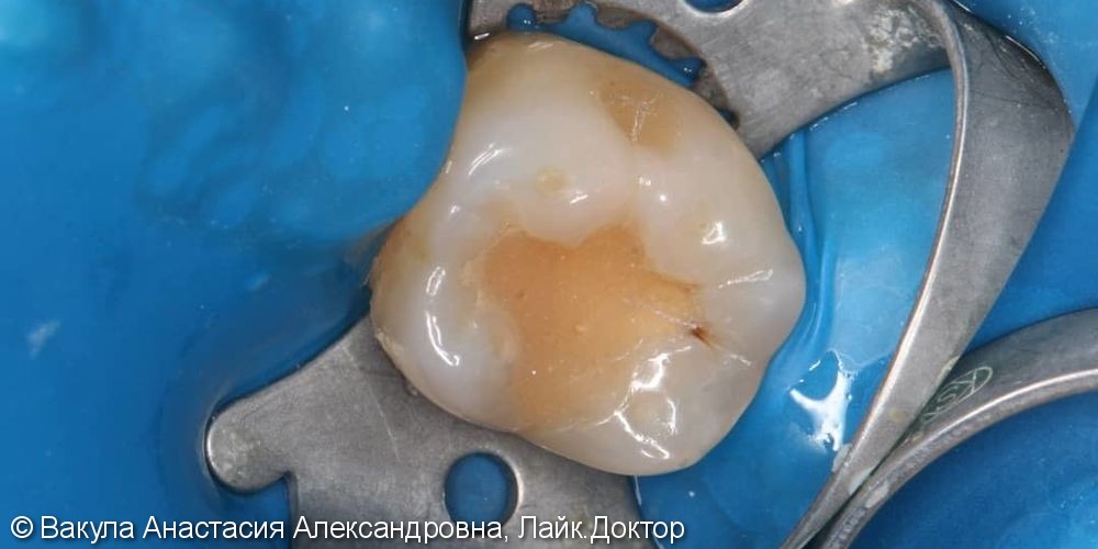 Лечение кариеса зуба 36, восстановление анатомической формы - фото №1